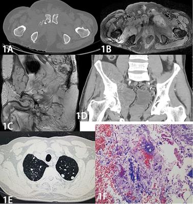 A correlation analysis of sacrococcygeal chordoma imaging and clinical characteristics with the prognostic factors